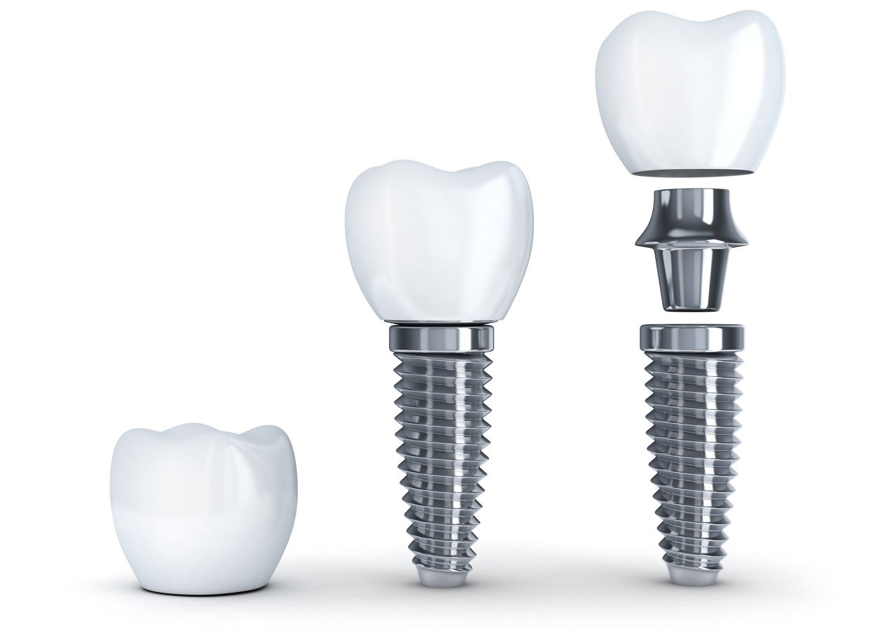 Dental Implants South Wales