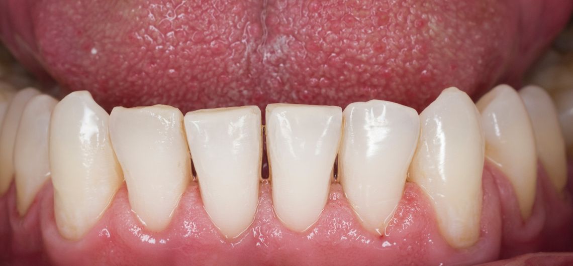 EMS GBT new hygiene future proofing dentistry 