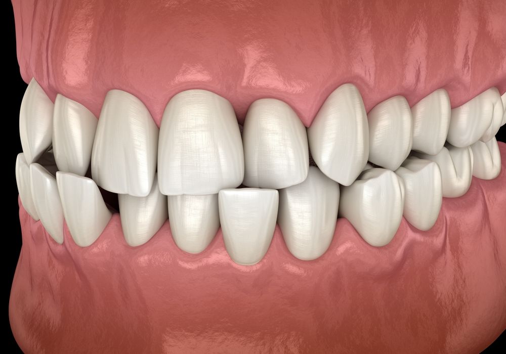 Angel Aligners Monmouth, South Wales