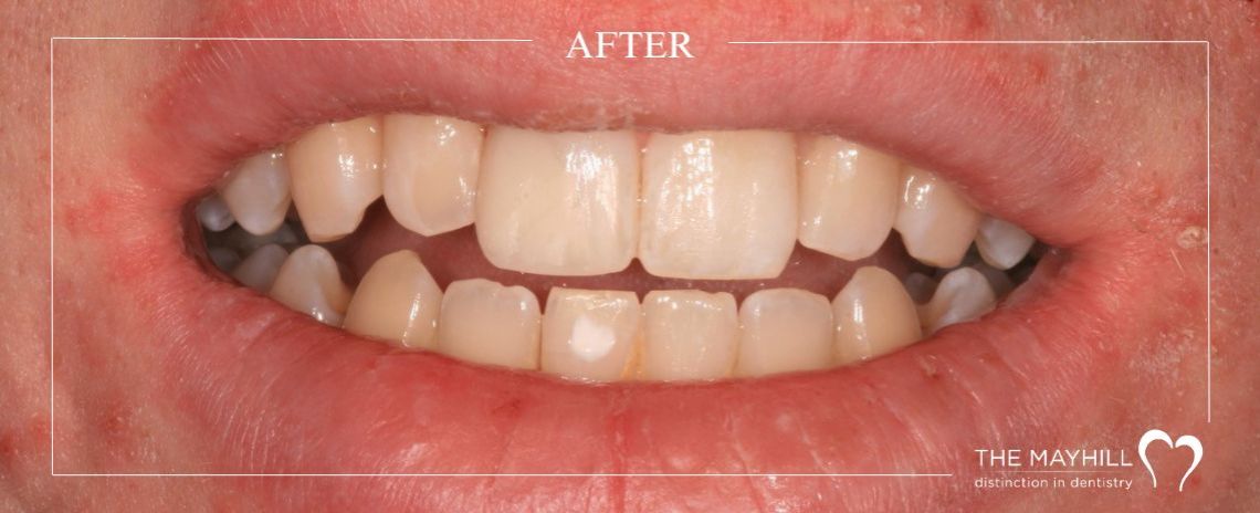 Composite build up After