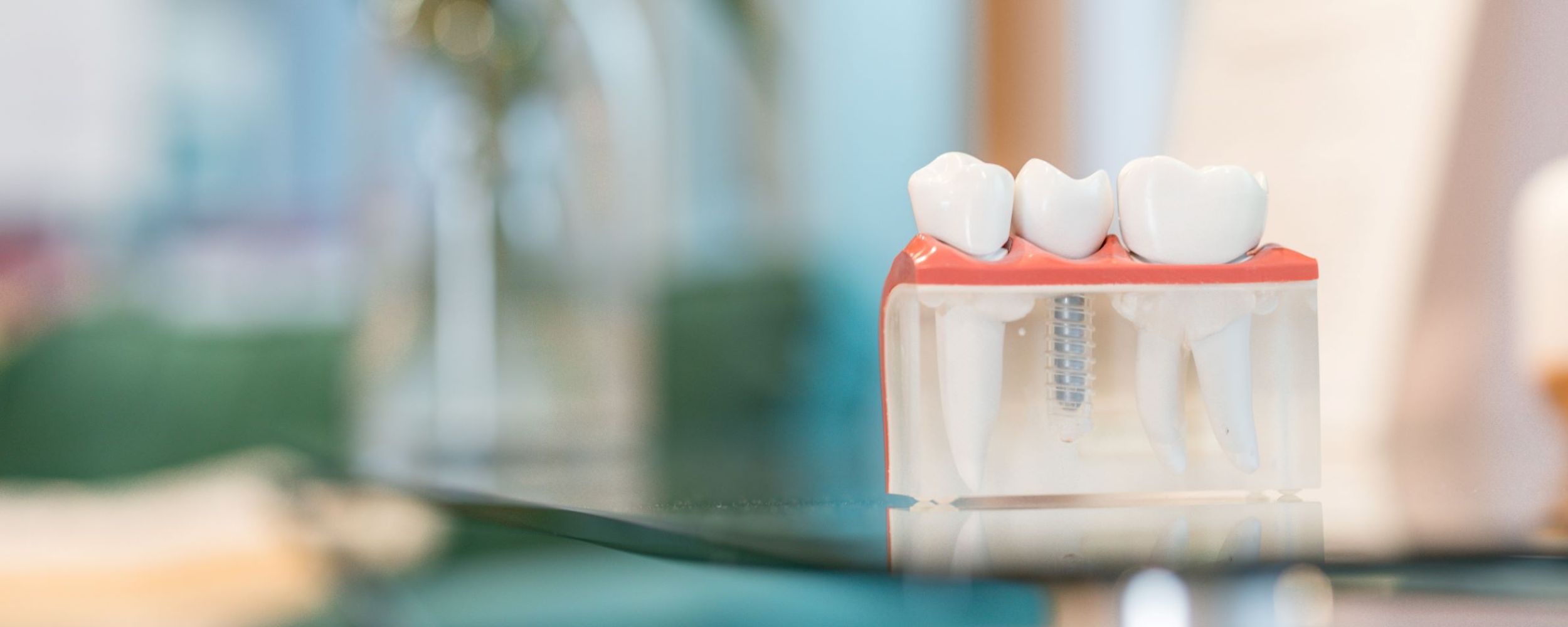 Dental Implants in South Wales