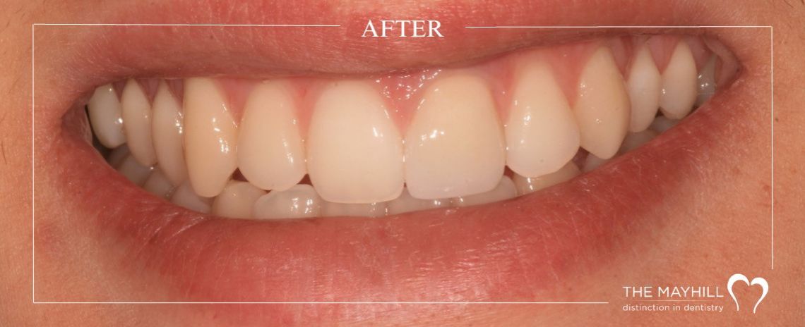  Dark tooth restoration After