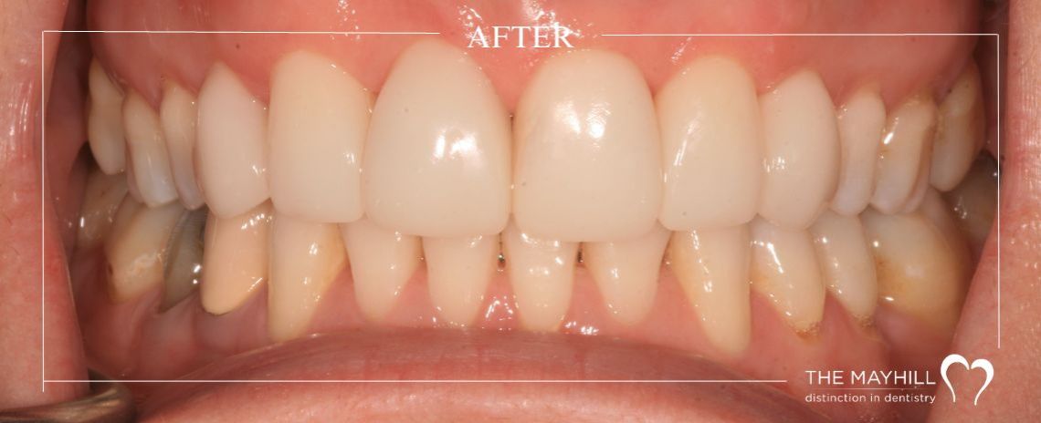 Orthodontics, Bonding & Whitening After