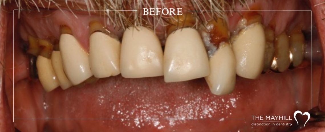Implant with restoration Before