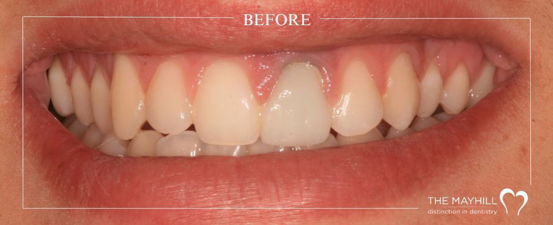  Dark tooth restoration Before
