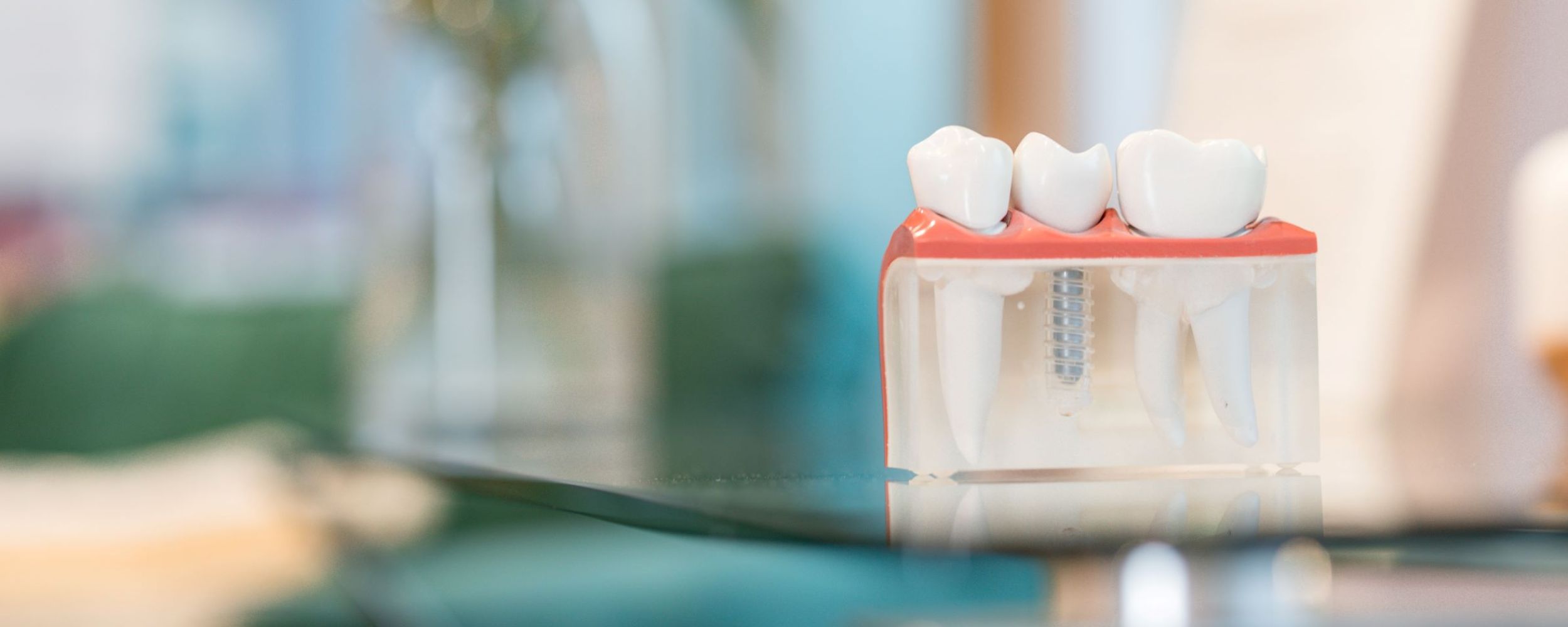 Multiple teeth dental implants