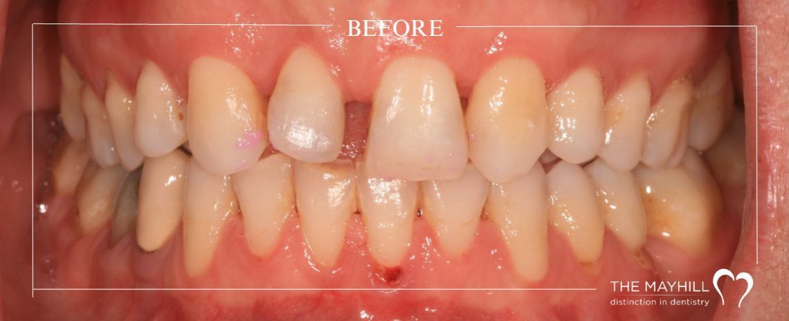 Orthodontics, Bonding & Whitening Before