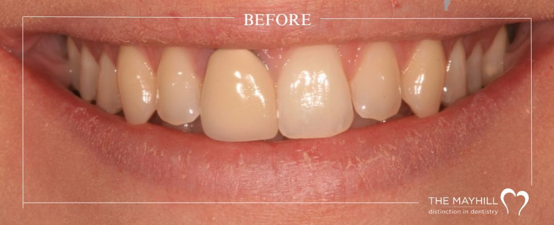  Single crown and Whitening Before