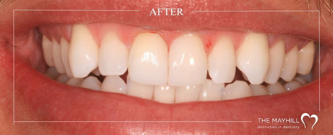  Internal & external whitening with Composite bonding After