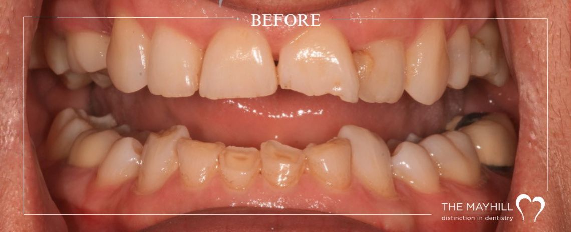 Bleaching and Composite bonding Before