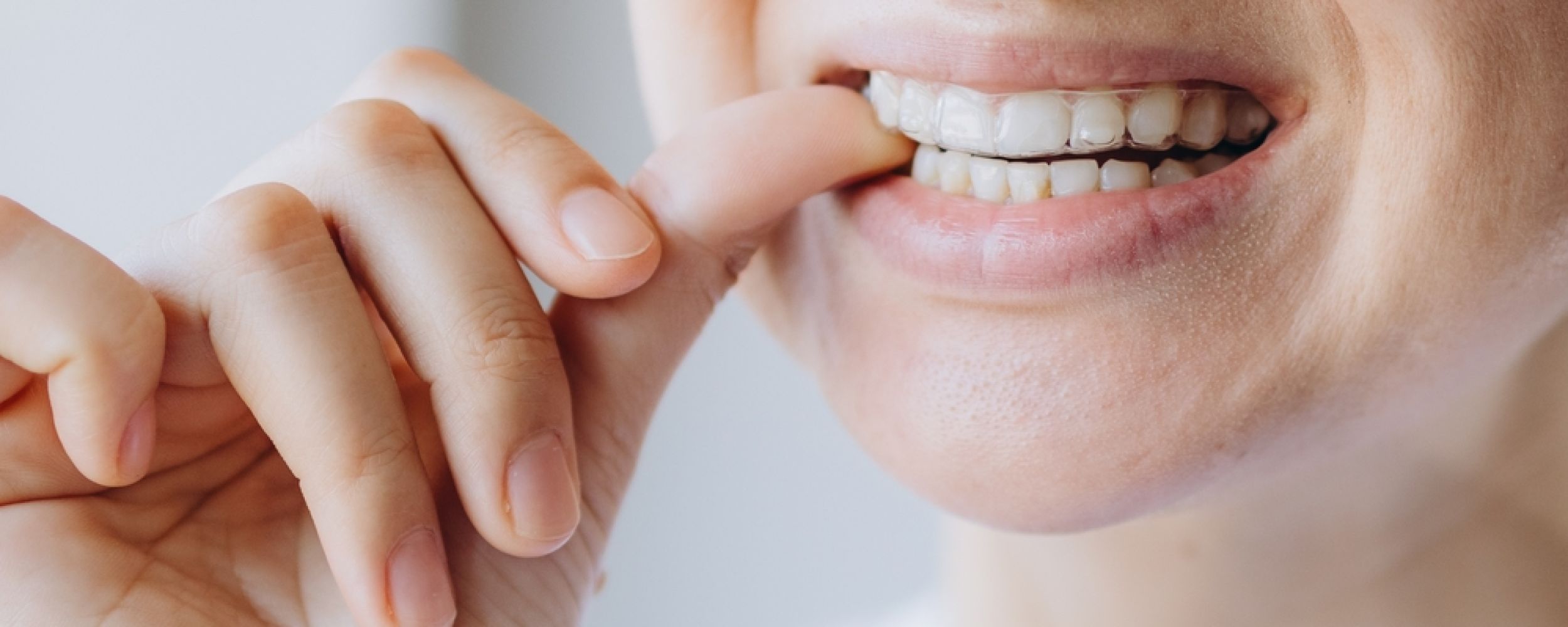 Angel Aligners