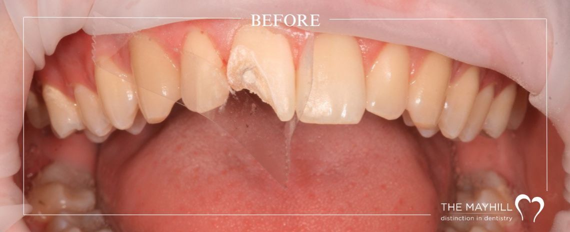 Composite build up Before