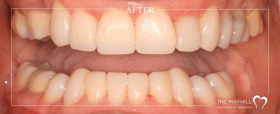 Bleaching and Composite bonding After