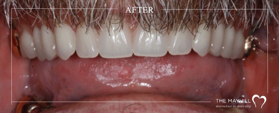Implant with restoration After