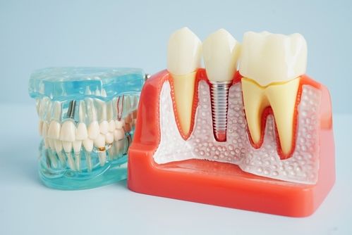 Dental Implants South Wales