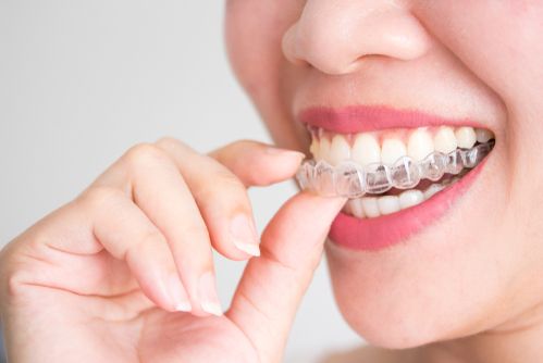 Invisalign South Wales