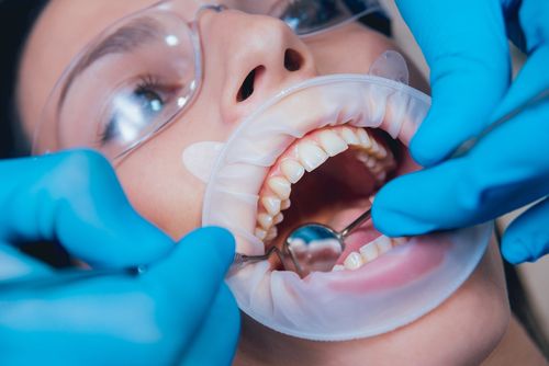 Root Canal South Wales