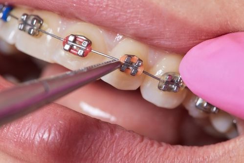 Invisalign versus Braces