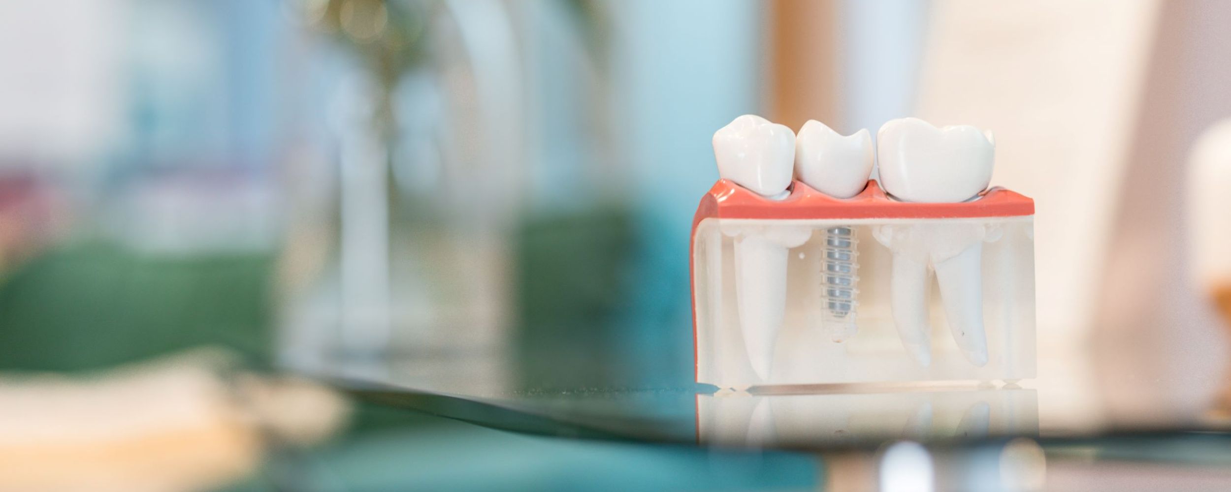 Single tooth dental implants