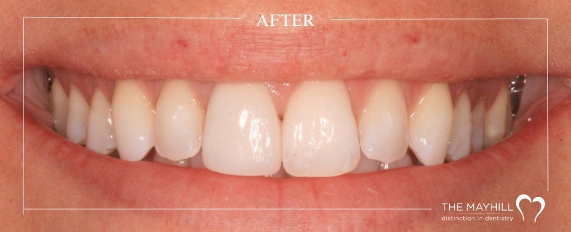  Single crown and Whitening After